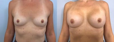 Breast Augmentation Before & After Gallery - Patient 48813387 - Image 1