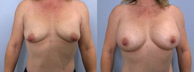 Breast Augmentation Before & After Gallery - Patient 48813397 - Image 1