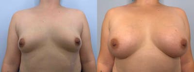 Breast Augmentation Before & After Gallery - Patient 48813402 - Image 1