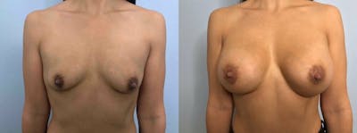 Breast Augmentation Before & After Gallery - Patient 48813410 - Image 1