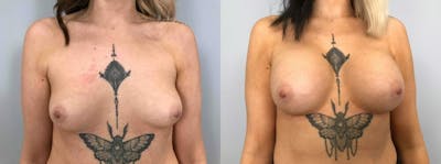 Breast Augmentation Gallery - Patient 48813417 - Image 1