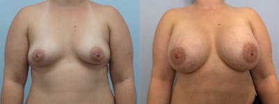 Breast Augmentation Before & After Gallery - Patient 48813423 - Image 1