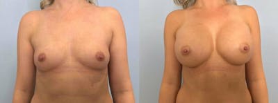 Breast Augmentation Before & After Gallery - Patient 48813444 - Image 1