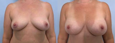 Breast Augmentation Before & After Gallery - Patient 48813451 - Image 1