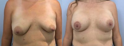 Breast Augmentation Before & After Gallery - Patient 48813459 - Image 1