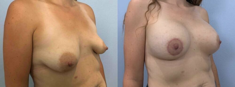 Breast Augmentation Gallery - Patient 48813459 - Image 2