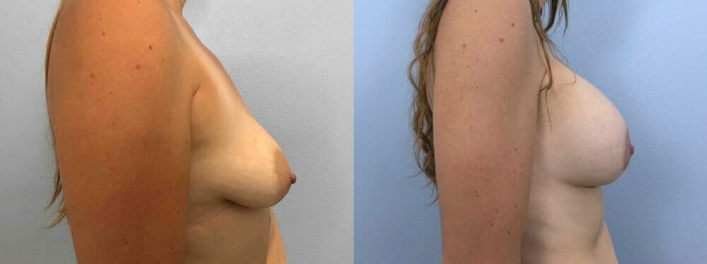 Breast Augmentation Gallery - Patient 48813459 - Image 3