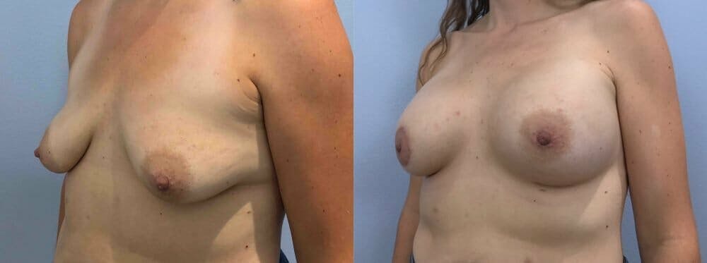 Breast Augmentation Gallery - Patient 48813459 - Image 4