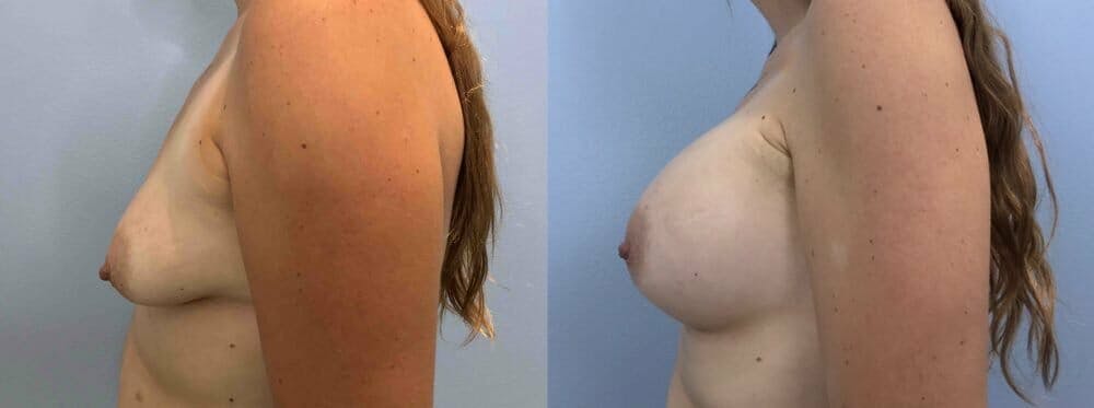Breast Augmentation Gallery - Patient 48813459 - Image 5