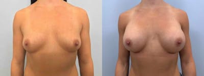 Breast Augmentation Before & After Gallery - Patient 48813465 - Image 1