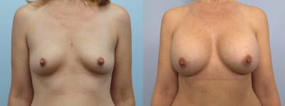 Breast Augmentation Before & After Gallery - Patient 48813472 - Image 1