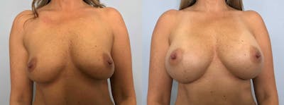 Breast Augmentation Before & After Gallery - Patient 48813479 - Image 1