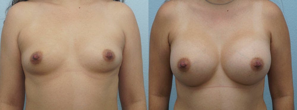 Breast Augmentation