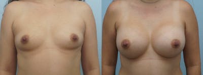 Breast Augmentation Before & After Gallery - Patient 48813487 - Image 1