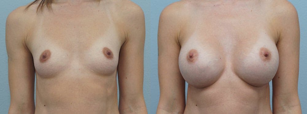 Breast Augmentation