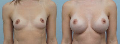 Breast Augmentation Before & After Gallery - Patient 48813501 - Image 1