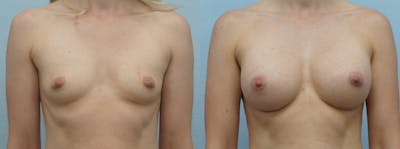 Breast Augmentation Before & After Gallery - Patient 48813514 - Image 1