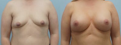 Breast Augmentation Before & After Gallery - Patient 48813524 - Image 1