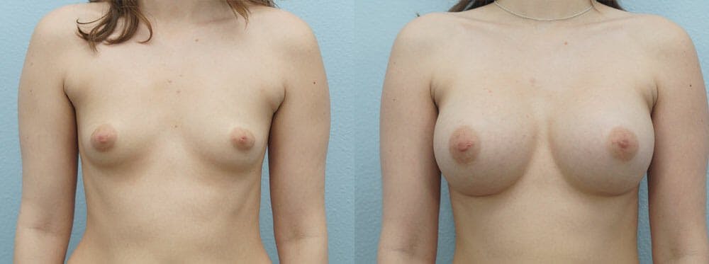 Breast Augmentation