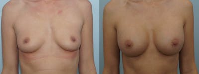 Breast Augmentation Before & After Gallery - Patient 48813547 - Image 1