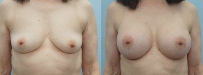 Breast Augmentation Before & After Gallery - Patient 48813558 - Image 1