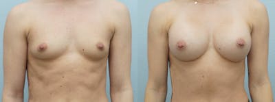 Breast Augmentation Before & After Gallery - Patient 48813569 - Image 1
