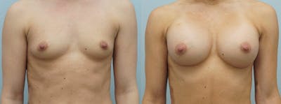Breast Augmentation Before & After Gallery - Patient 48813577 - Image 1