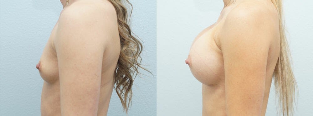 Breast Augmentation Gallery - Patient 48813577 - Image 3