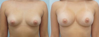 Breast Augmentation Before & After Gallery - Patient 48813585 - Image 1