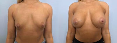 Breast Augmentation Before & After Gallery - Patient 48813600 - Image 1