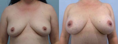 Breast Augmentation Before & After Gallery - Patient 48813608 - Image 1