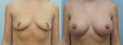 Breast Augmentation Before & After Gallery - Patient 48813614 - Image 1