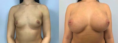 Breast Augmentation Before & After Gallery - Patient 48813623 - Image 1