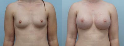 Breast Augmentation Before & After Gallery - Patient 48813631 - Image 1