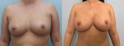 Breast Augmentation Before & After Gallery - Patient 48813637 - Image 1