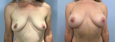 Breast Augmentation Before & After Gallery - Patient 48813644 - Image 1