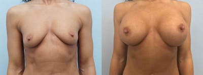 Breast Augmentation Before & After Gallery - Patient 48813660 - Image 1