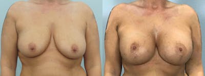Breast Lift With Implants Before & After Gallery - Patient 48813661 - Image 1