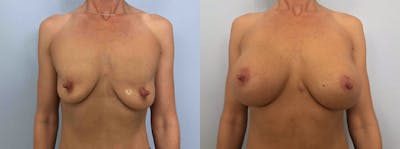 Breast Augmentation Before & After Gallery - Patient 48813666 - Image 1