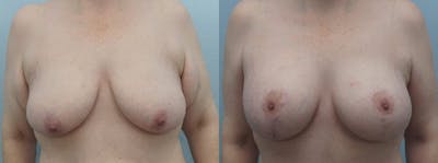 Breast Lift With Implants Before & After Gallery - Patient 48813670 - Image 1