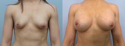 Breast Augmentation Before & After Gallery - Patient 48813676 - Image 1