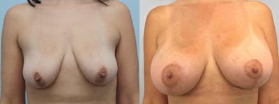 Breast Lift With Implants Before & After Gallery - Patient 48813675 - Image 1