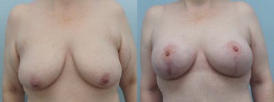 Breast Lift With Implants Before & After Gallery - Patient 48813683 - Image 1