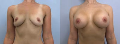 Breast Augmentation Before & After Gallery - Patient 48813681 - Image 1