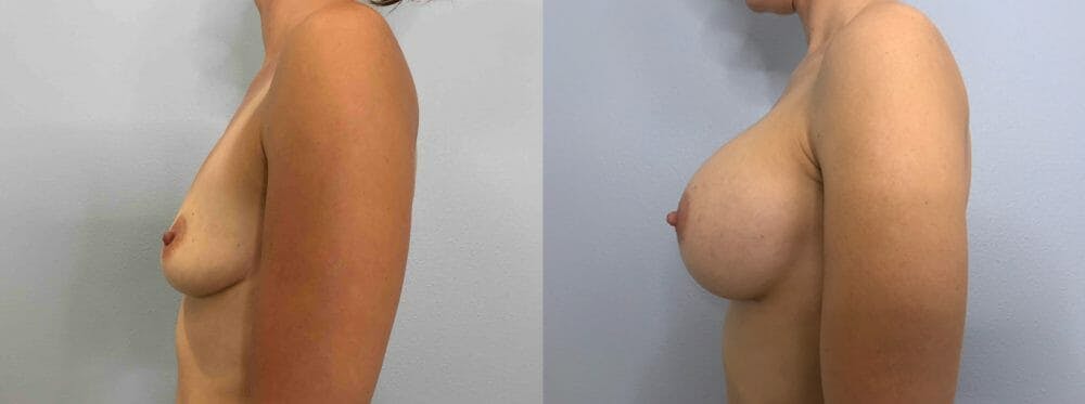 Breast Augmentation Gallery - Patient 48813681 - Image 3