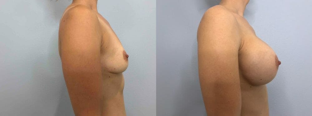 Breast Augmentation Gallery - Patient 48813681 - Image 5