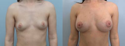 Breast Augmentation Before & After Gallery - Patient 48813693 - Image 1