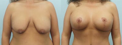 Breast Lift With Implants Before & After Gallery - Patient 48813695 - Image 1
