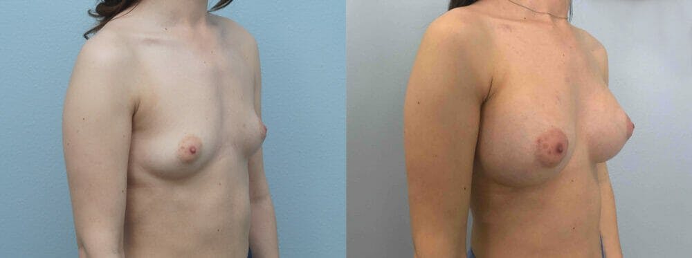 Breast Augmentation Gallery - Patient 48813693 - Image 3