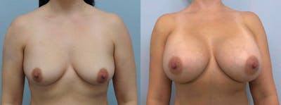 Breast Augmentation Before & After Gallery - Patient 48813699 - Image 1